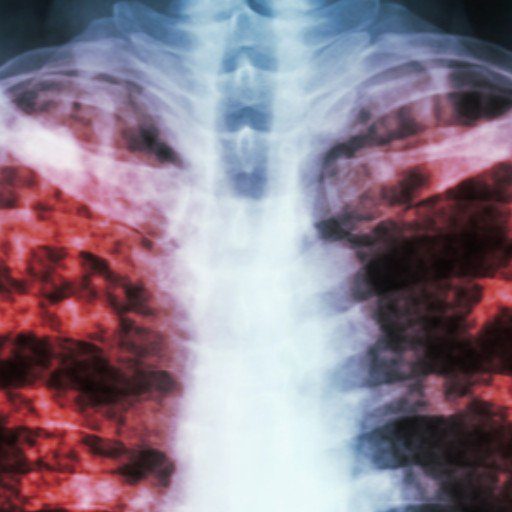 FOTO NOTA SILICOSIS 1