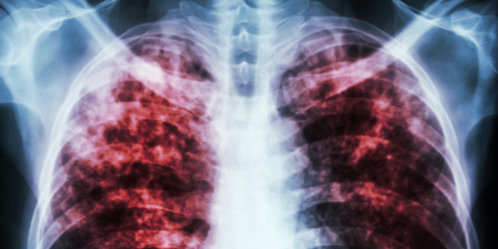 FOTO NOTA SILICOSIS 1
